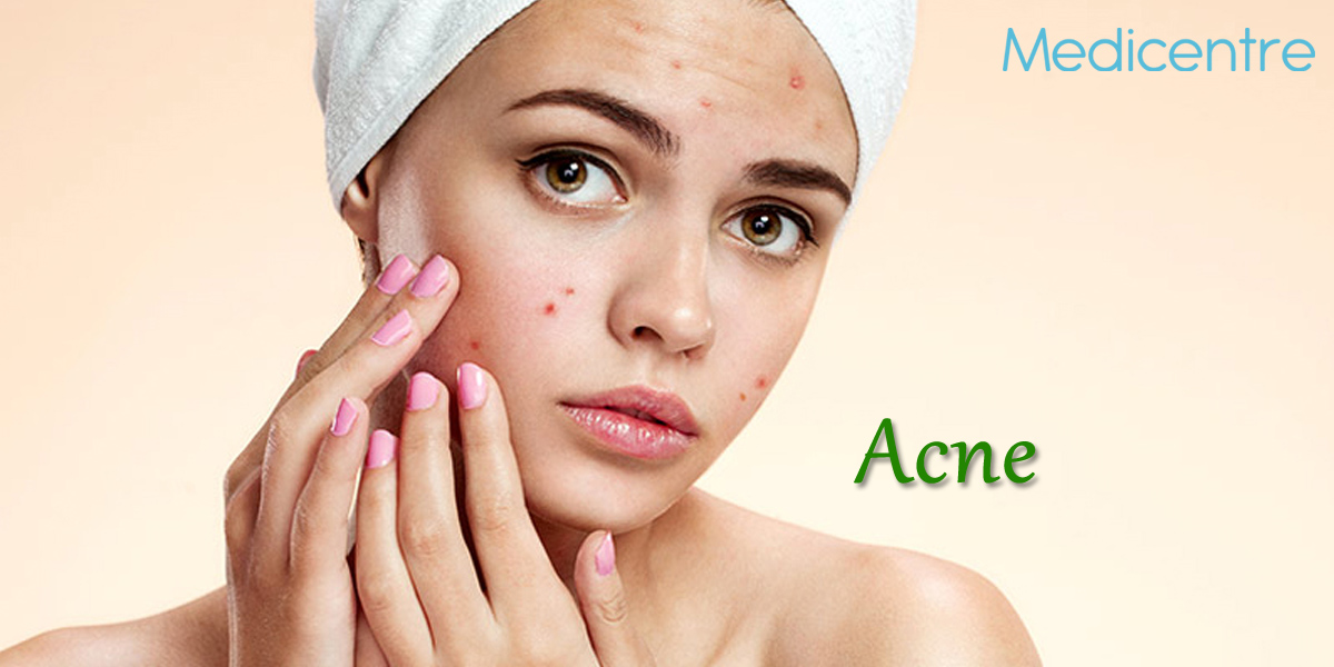 Acne and acne scar treatment gurgaon