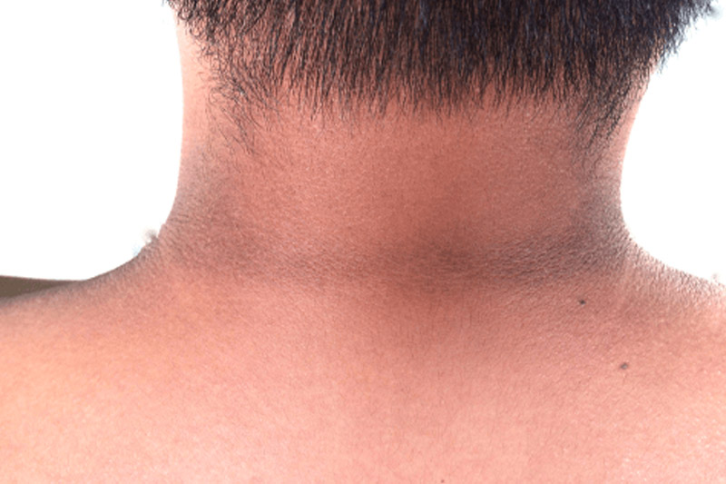 Acanthosis Nigricans Causes Symptoms And Treatments