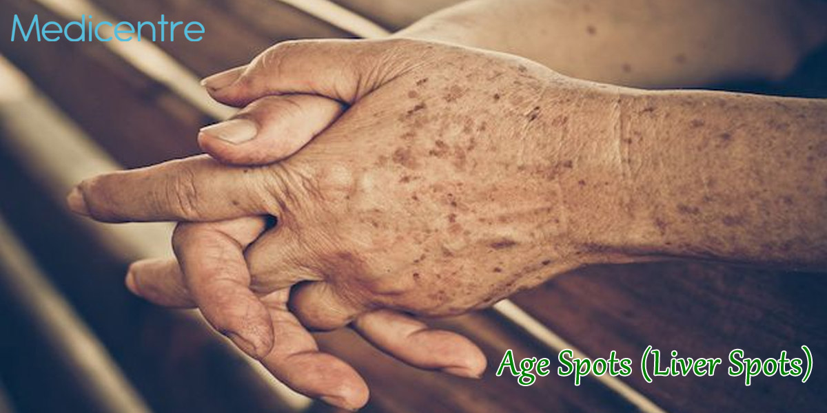 Age Spots Liver Spots Causes Symptoms And Treatments