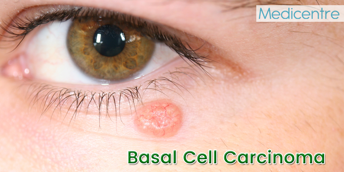 Basal Cell Carcinoma Causes Risks Symptoms Treatment My Xxx Hot Girl